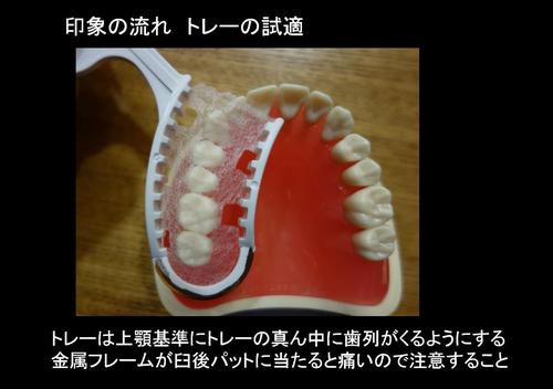 印象・咬合採得が同時にできる【咬合印象法】の手順 咬合印象用トレー - EE DENTAL_Blog